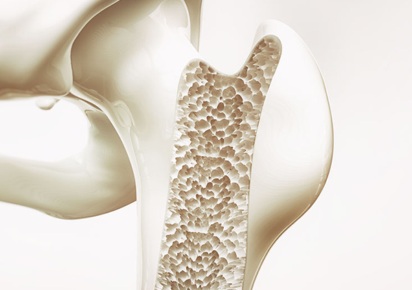精度の高い骨粗鬆症診断装置（DXA法）を用いた骨粗鬆症診断、治療